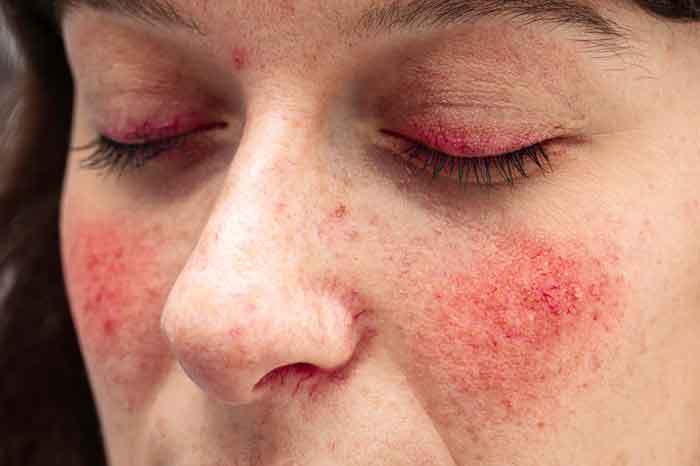 How To Calm Rosacea Flare Up?