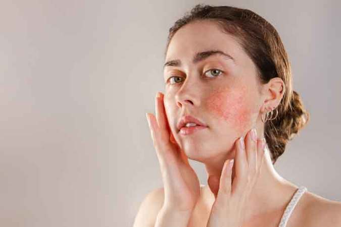 How To Calm Rosacea Flare Up A Complete Guide