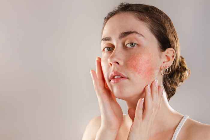 How To Calm Rosacea Flare Up?