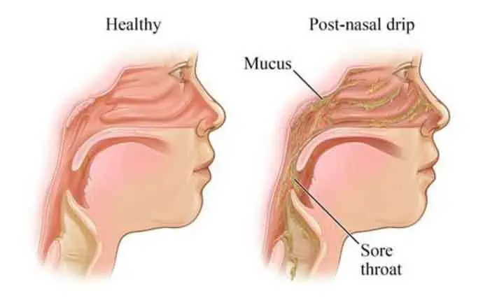 What is a post nasal drip?